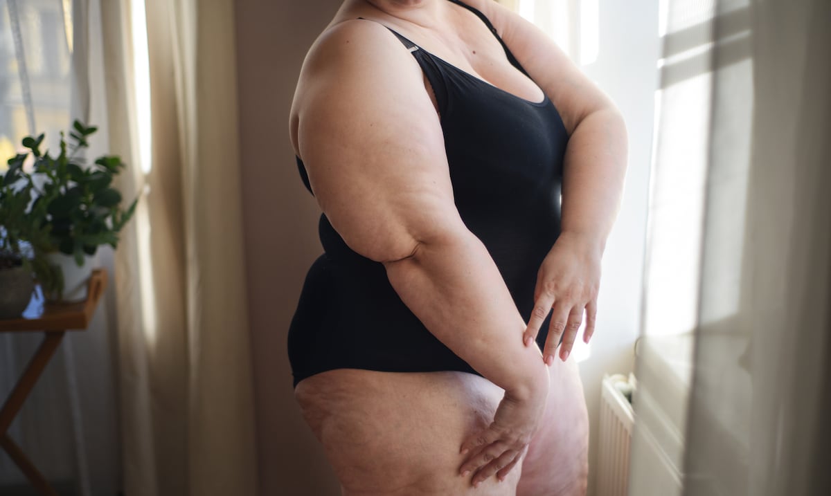 Exceso de grasa en brazos y piernas: ¿lipedema u obesidad mórbida?