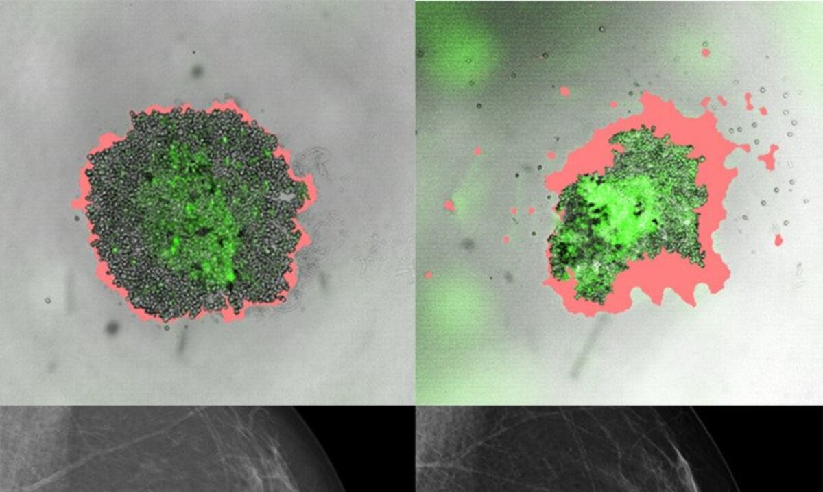 Nuevo método para buscar el mejor fármaco para cada paciente de cáncer de mama
