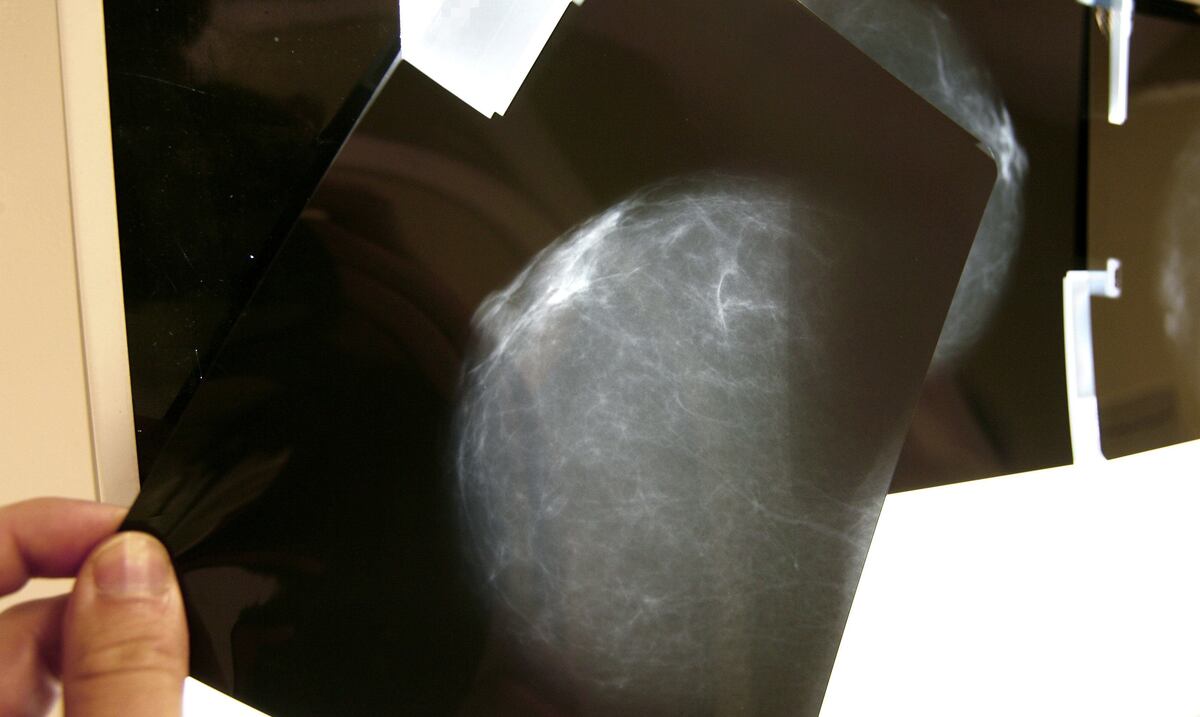 Desarrollan predictor de riesgo de progresión de células precancerosas de mama