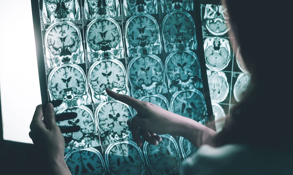 No realizar ejercicio físico: un factor de riesgo para el alzhéimer