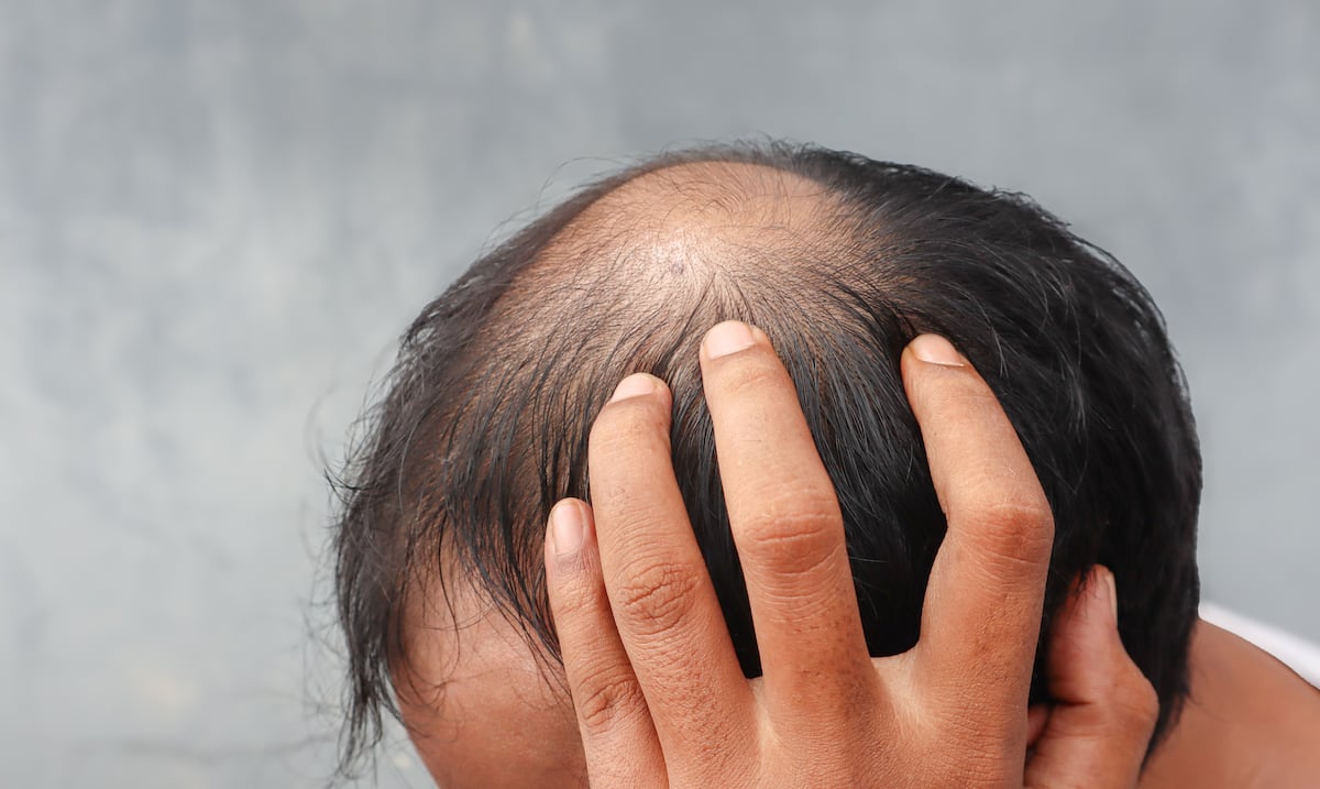 Adiós a la calvicie: un estudio encontró sorprendentes beneficios en un alimento para la alopecia