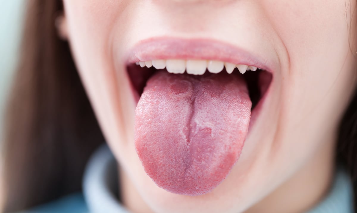 ¿Por qué salen ampollas y puntos rojos en la lengua? Estas son las causas más frecuentes 