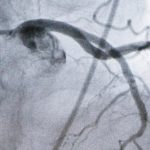 Píldora experimental para reducir el colesterol podría ofrecer una nueva opción a millones de personas