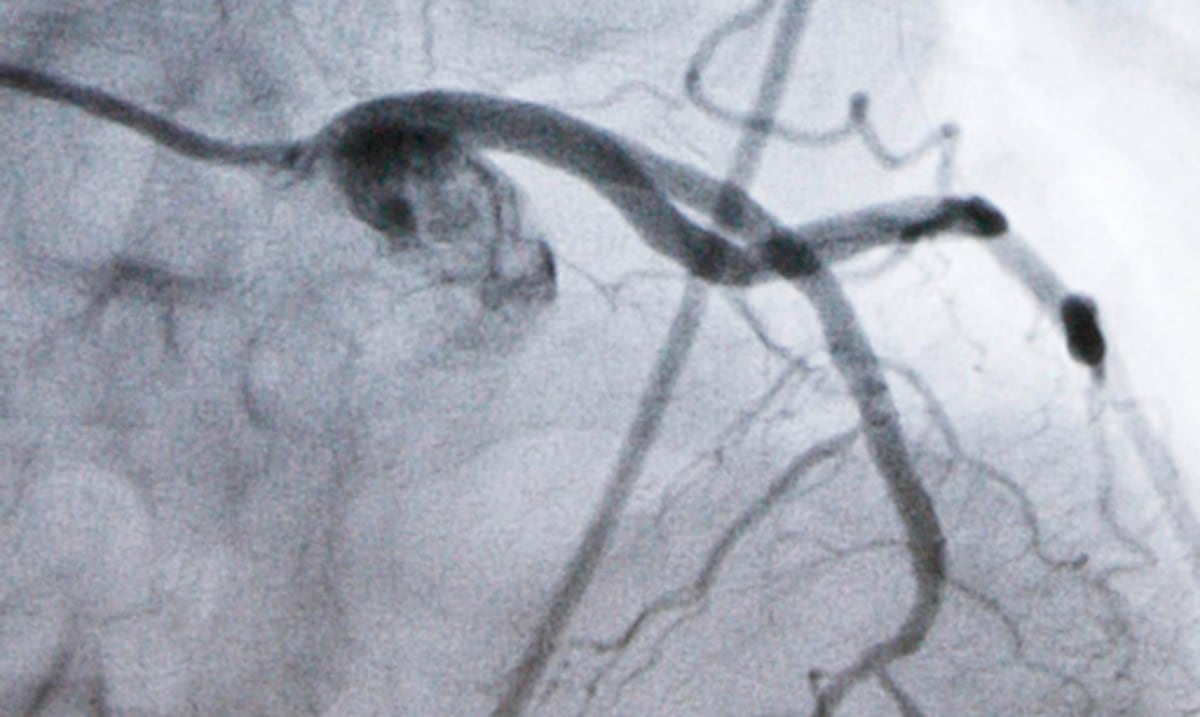 Píldora experimental para reducir el colesterol podría ofrecer una nueva opción a millones de personas