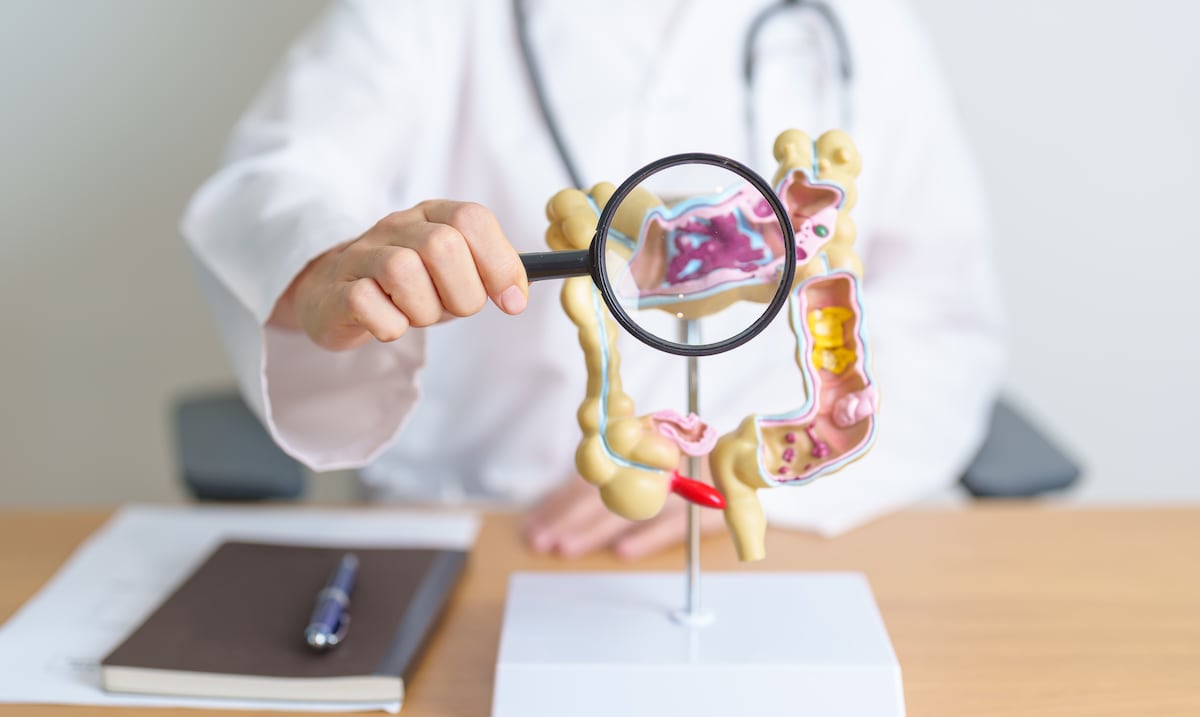 Cáncer colorrectal en aumento: conoce las señales de alerta