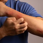 Ante el alza en calor: cómo protegerse de la piel aquellos que padecen de psoriasis
