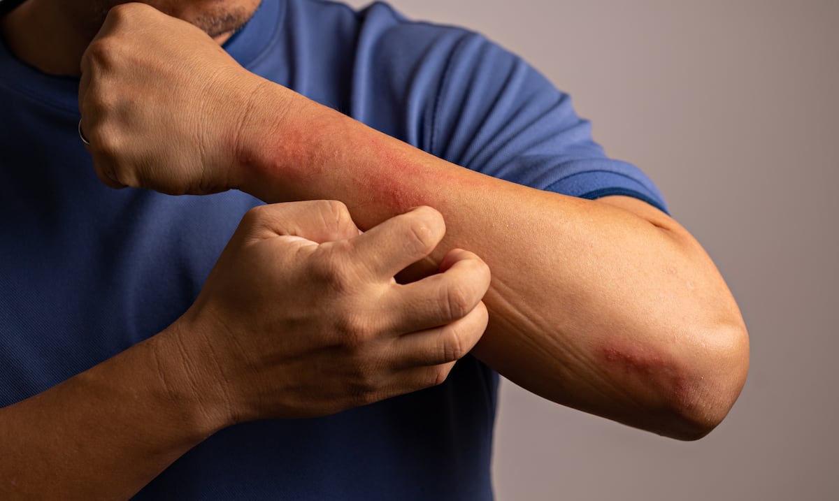 Ante el alza en calor: cómo protegerse de la piel aquellos que padecen de psoriasis