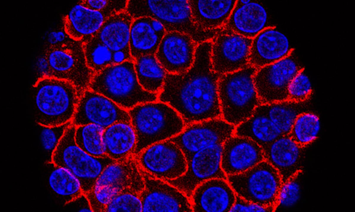 “Es un gran paso”: píldora experimental promete nueva esperanza contra el mortal cáncer de páncreas