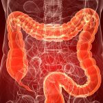 5 prácticas que ayudan a prevenir el cáncer colorrectal