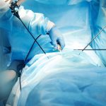 ¿Qué es una laparoscopia?