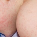 8 datos sobre la dermatitis atópica