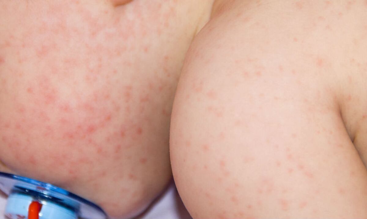 8 datos sobre la dermatitis atópica