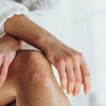 Invitan a pacientes a participar del primer estudio exploratorio sobre psoriasis en Puerto Rico