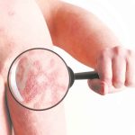 Jornada de atención al paciente de psoriasis