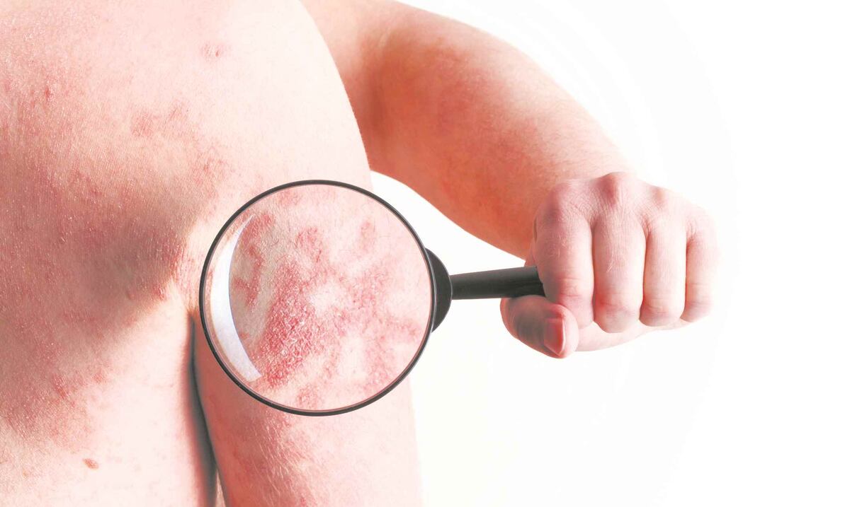 Jornada de atención al paciente de psoriasis