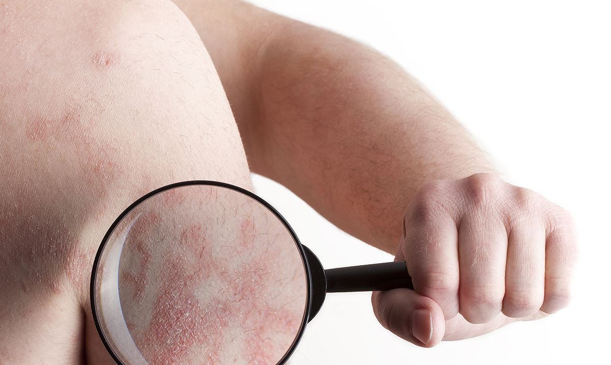 El vínculo entre la psoriasis y la salud mental