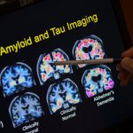 ¿Quieres reducir el riesgo de demencia? No necesitas un análisis de sangre
