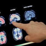 Vivir más tiempo podría aumentar el riesgo de demencia, pero hay formas de reducirlo