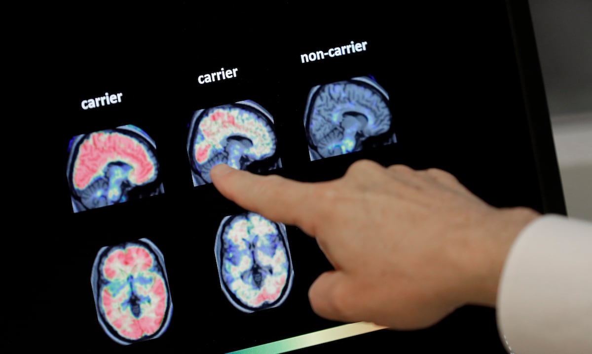 Vivir más tiempo podría aumentar el riesgo de demencia, pero hay formas de reducirlo